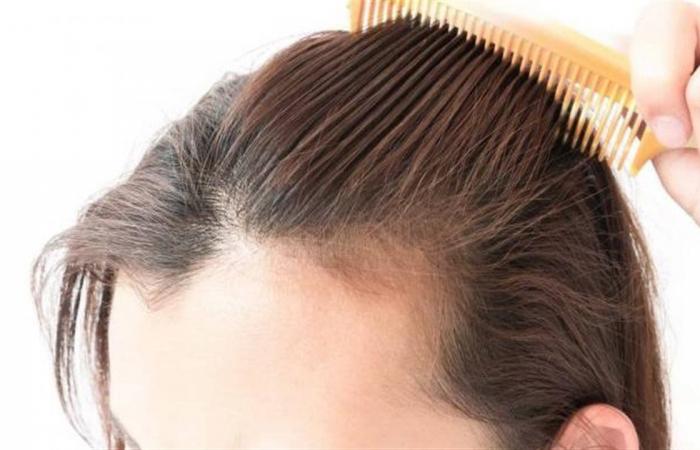 علاج
      فعّال
      لتساقط
      الشعر
      يحقق
      نتائج
      ملحوظة
      خلال
      شهرين
      فقط