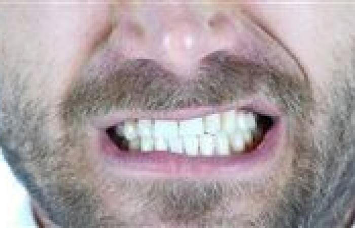 كارثة
      تبييض
      الأسنان..
      منتجات
      "قاتلة"
      تباع
      عبر
      الإنترنت
      تهدد
      بابتسامة
      مدمّرة