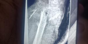 مستشفى
      الفيوم
      العام
      تنقذ
      حياة
      سيدة
      مسنّة
      بعد
      سقوط
      من
      علو
      وتجري
      جراحة
      ميكروسكوبية
      دقيقة
      باليد