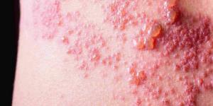 بمناسبة التوعية العالمية به.. الوقاية لا تقل أهمية عن العلاج لمرض الحزام الناري