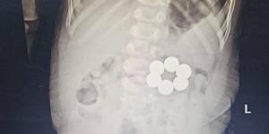 إنقاذ رضيع ابتلع 6 قطع مغناطيس في جراحة دقيقة بمستشفى الأطفال الجامعي بالمنصورة