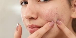 حب الشباب.. الأسباب الخفية والعلاجات الحديثة