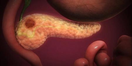 "الخطوة
      الأهم
      منذ
      50
      عاما"..
      اختبار
      تنفس
      ثوري
      يكشف
      سرطان
      البنكرياس
      مبكرا