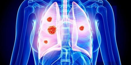 اكتشاف المحرك الرئيسي لتطور سرطان الرئة في مراحله المبكرة