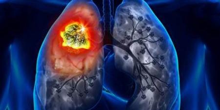 ليس التدخين وحده.. الالتهاب هو كلمة السر وراء أخطر مراحل سرطان الرئة