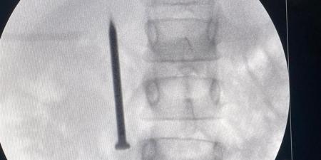 فريق طبي بمعهد الكبد بالمنوفية يستخرج مسمارا من أمعاء طفلة في 20 دقيقة