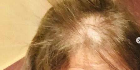 ارتكبوا جريمة في حقي.. رحمة حسن توجه رسالة مؤثرة بعد تساقط شعرها