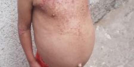 جودى حنون.. طفلة فلسطينية فقدت شقيقتيها وتعانى من مرض خطير يحتاج لزراعة نخاع