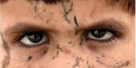 آدم أبو حليب.. طفل فلسطينى قصف منزله.. فقد شقيقه ويواجه خطر فقدان عينيه