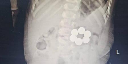 إنقاذ رضيع ابتلع 6 قطع مغناطيس في جراحة دقيقة بمستشفى الأطفال الجامعي بالمنصورة