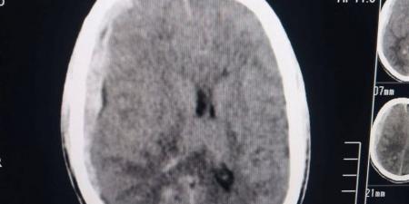 إنقاذ حياة شاب أصيب في رأسه بألة حادة في دمياط