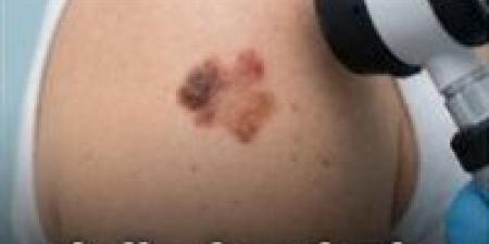 “إشارات علي جلدك ممكن تنقذ حياتك.. تجاهلها ممكن يكلفك كتير