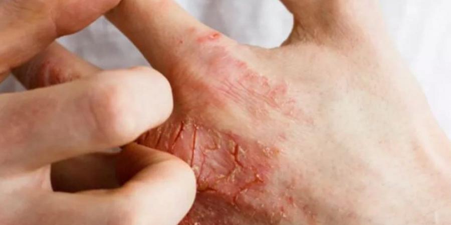 كل
      ما
      تحتاج
      معرفته
      عن
      التهاب
      الجلد
      الدهني
      وأفضل
      طرق
      الوقاية
      منه