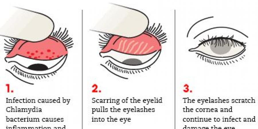 مصر تسجل إنجازًا صحيًا تاريخيًا.. القضاء على التراكوما وإعلان خلو البلاد من المرض