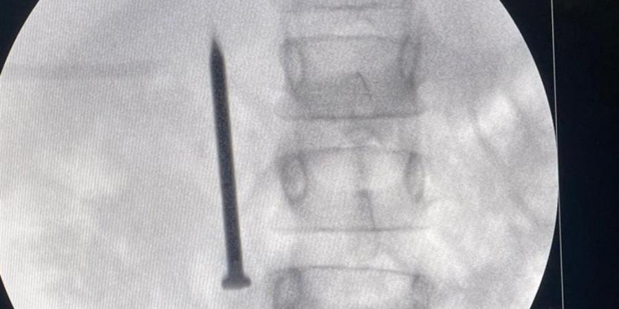 فريق طبي بمعهد الكبد بالمنوفية يستخرج مسمارا من أمعاء طفلة في 20 دقيقة