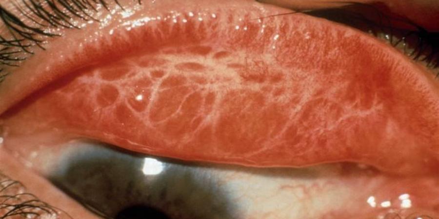 مصر تنتصر على العمى المعدى.. القضاء النهائى على "التراخوما"