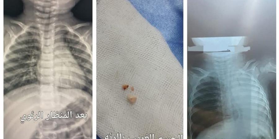 فريق طبي بالشرقية ينقذ طفلًا بعد توقف تنفسه بسبب "فول ناشف"