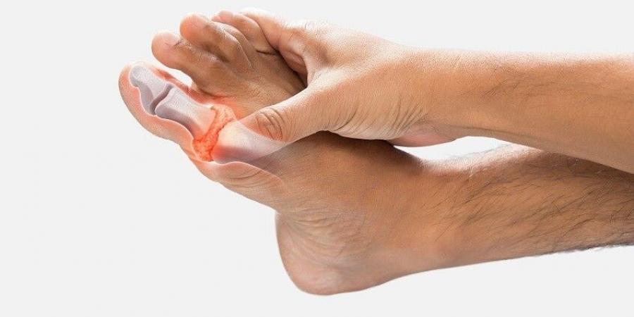 مرض الملوك.. أسباب وأعراض وطرق تخفيف ألم المفاصل الناتجة عن النقرس