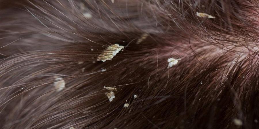 سبب خفي وراء قشرة الرأس المزعجة