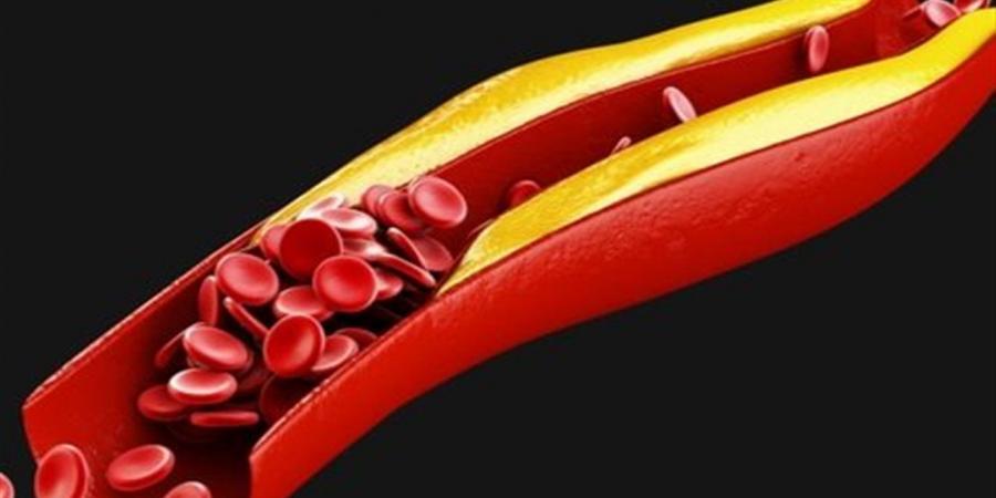 جرعة واحدة من دواء جديد قد تخفّض الكوليسترول مدى الحياة