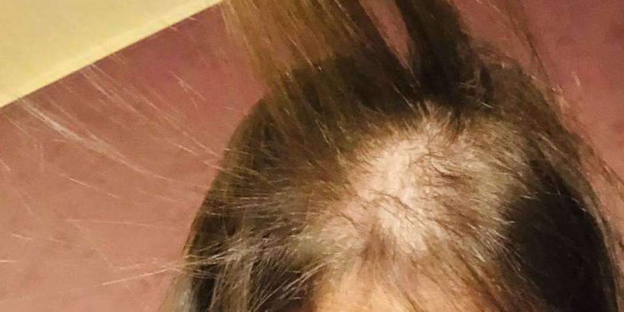 تهديد بالصلع وعاهة مستديمة.. القصة الكاملة لـ أزمة شعر رحمة حسن