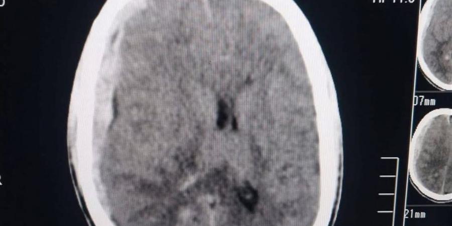 إنقاذ حياة شاب أصيب في رأسه بألة حادة في دمياط