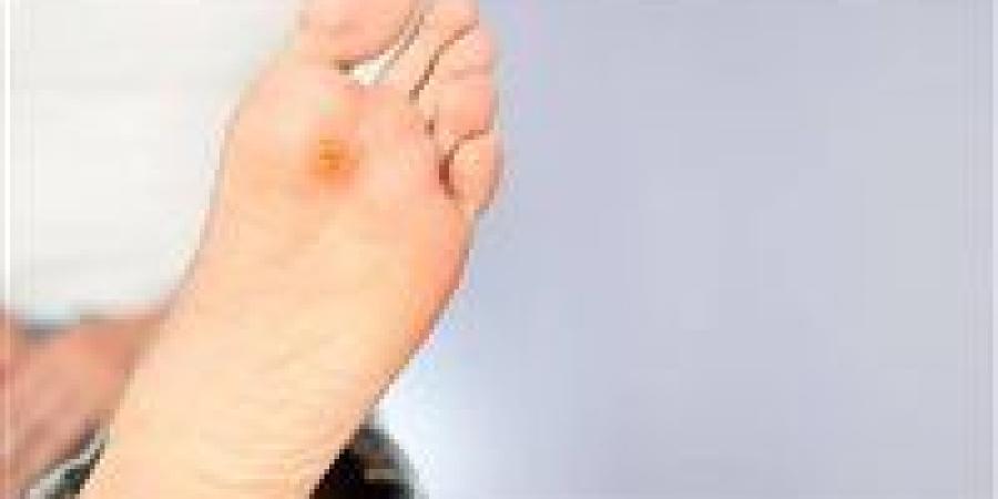 مسامير القدم العظمية.. أسبابها وطرق الوقاية كما يوضح الأطباء