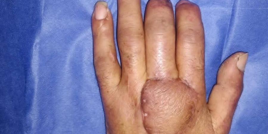 جراحة نادرة بمستشفى المحلة العام لترميم كف يد مريض