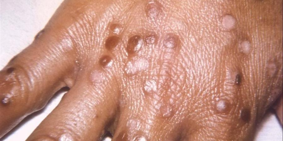 قبل «هانتا» و«كورونا».. قصة فيروس قتل 500 مليون إنسان